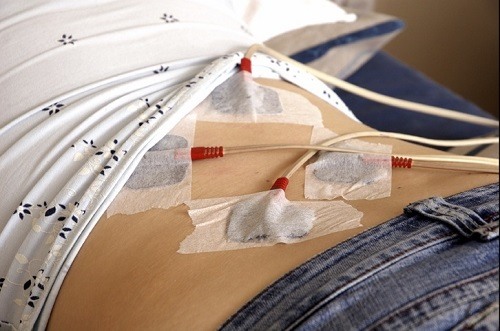 placement of Tens electrodes on for treating female lower back area